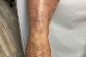 Spider Vein Removal Cape Coral | The Process of Spider Vein Removal