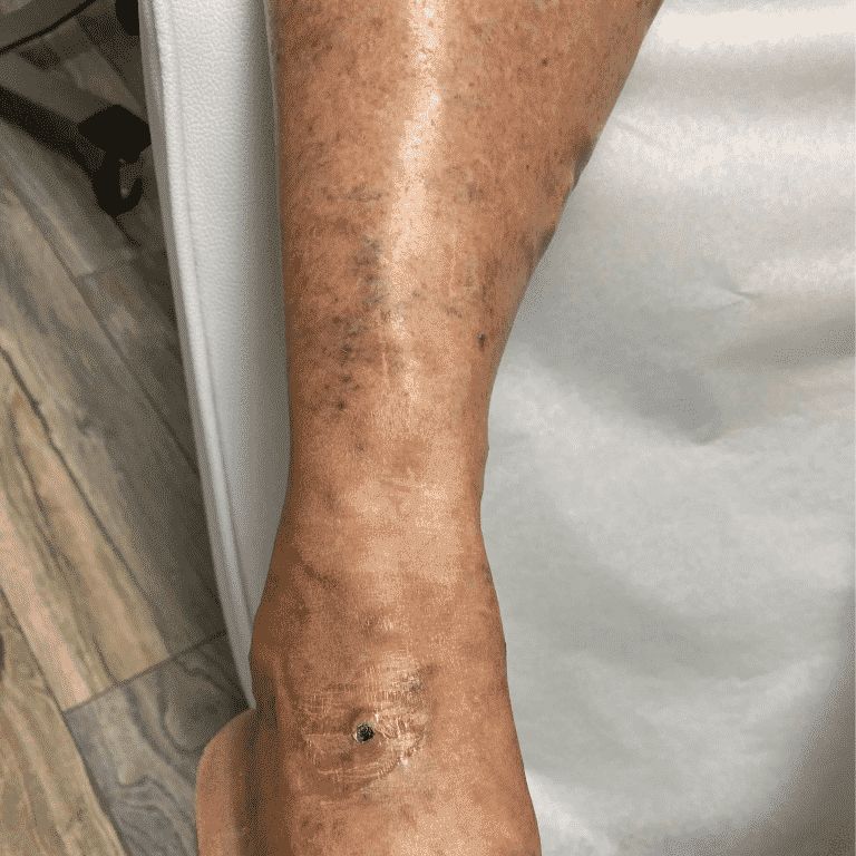 Spider Vein Removal Cape Coral | The Process of Spider Vein Removal