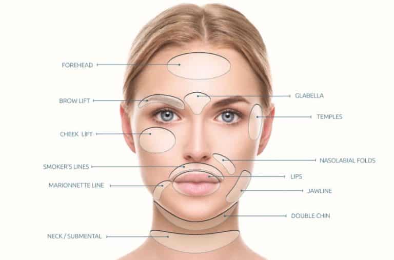 PDO Thread Face Lifts | PDO Thread Body Lifts | Cosmetics in Cape