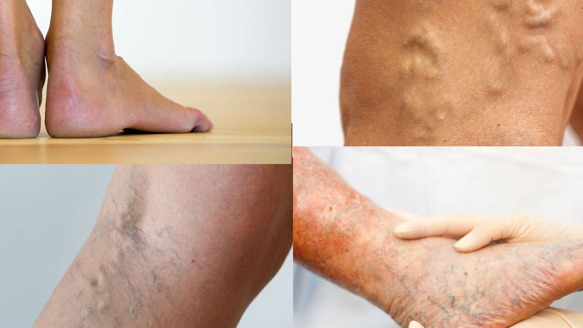 Venous Insufficiency and Treatment Options: Best Solutions for Relief in 2025